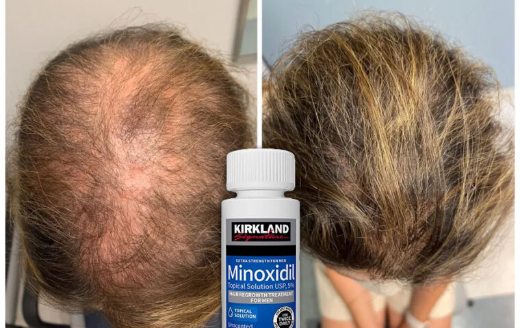 Minoxidil Kirkland
